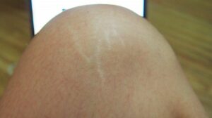 Nguyên nhân rạn da đầu gối là gì? Hướng dẫn cách điều trị an toàn